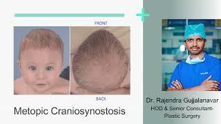 Metopic Craniosynostosis | Sakra World Hospital