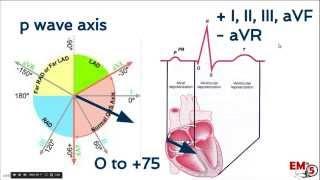 EKG interpretation  axis