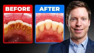 The #1 Top Remedy for Dental Plaque