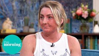 Eczema Warrior Amy Aston on Her Battle and Steroid Withdrawal Awareness | This Morning