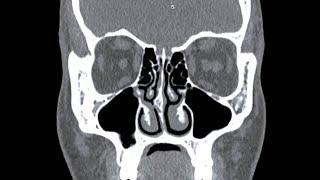 How to read a CT PNS |  All points Explained in detail