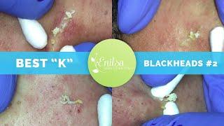 "K's" Best Blackhead Extraction Compilation Part #2