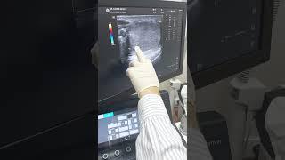 3rd Day Control Examination after Varicocele Surgery with Istanbul Varicocelectomy Technique