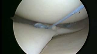 meniscal repair using fastfix S&N