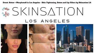 Botox + Morpheus8 in Los Angeles - Skin Tightening, Botox and Lip Fillers by Skinsation LA