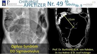 Ogilvie-Syndrom DD Sigmavolvulus CHIRURGIE APPetizer Nr.49/ AB TABULA Nr. 9