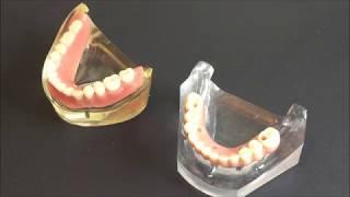 Implant supported denture vs implant retained denture - Bauer Smiles