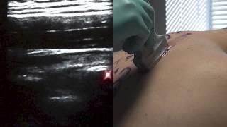 Ultrasound Guided Paravertebral Block - SSRAUSA.com