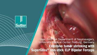 Extensive tumor shrinking with SuperGliss® non-stick ELP Bipolar Forceps