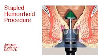 PPH Procedure Animation | Stapled Hemorrhoid Surgery | J&J MedTech