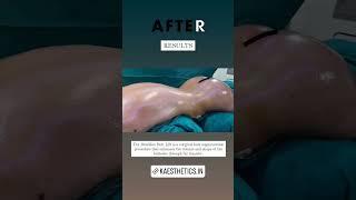 Brazilian Butt Lift Before and After | Dr Karishma Kagodu best plastic surgeon in Bengaluru #Shorts