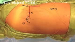 Basic Hip Arthroscopy: Anatomic Establishment of Arthroscopic Portals Without Fluoroscopic Guidance