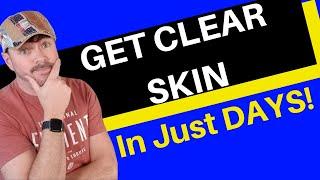 Get Clear Skin In Days | 3 Steps To End Acne | CHRIS GIBSON