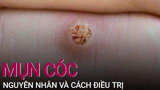 Mụn cóc: Nguyên nhân và cách điều trị | VTC Now