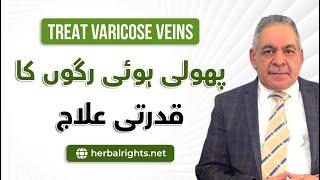 Live SEHAT AUR HIKMAT TOPIC VARICOSE VENIS :PRECAUTIONS &KA NATURAL ILAJ 28-06-24