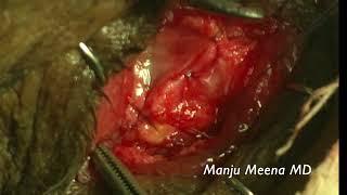 Enucleation by myoconjunctival technique by Dr Manju Meena, Oculoplastic Surgeon