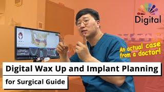 Digital Highlight - Digital Wax Up and Implant Planning for Surgical Guide