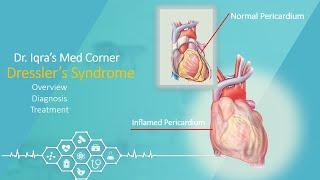 Dressler's Syndrome | Post Myocardial Infarction | Post-traumatic pericarditis| Dr Iqra's Med Corner