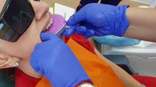 Снятие зубного слепка (оттиска) с челюстей