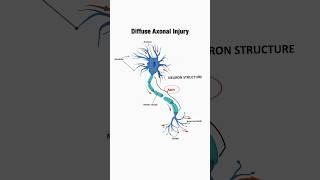 What is diffuse axonal injury (relating to Traumatic Brain Injury)