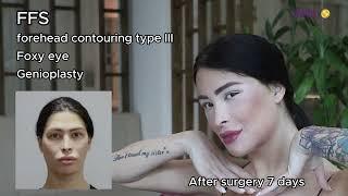 Alessandra Langella's Transformation: Facial Feminization Journey at Kamol Hospital