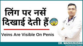 लिंग पर नसों का दिखना ! || Veins Are Visible On The Penis || Dr. Madhusudan