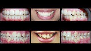 Invisalign for Treating Crowding Teeth and Crossbite at Cosmetic Dental Associates