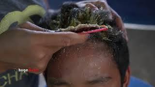 Removal Big Flakes With Comb!! - Satisfying Dandruff Scalp ! Dandruff Scratching #125