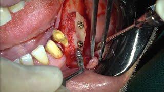 Horizontal ridge augmentation using bone block.