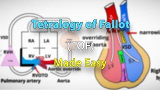 Tetralogy of Fallot (TOF) anatomy, pathophysiology, clinical features and diagnosis | Made easy