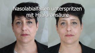 Nasolabialfalten unterspritzen mit Hyaluronsäure