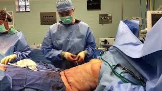 Abdominoplasty (Tummy Tuck) with Liposuction