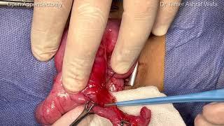 Appendectomy - Dr. Tamer Ashraf