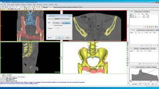 How to Use Split Mask in Mimics | Mimics Innovation Suite | Materialise Medical