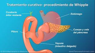 Cáncer de páncreas: tratamiento y resultados