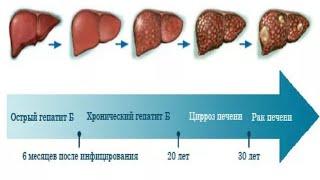 Гепатити В