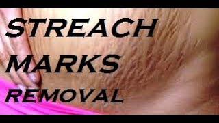 stretch marks|sumans' world|natural remedies for stretch marks