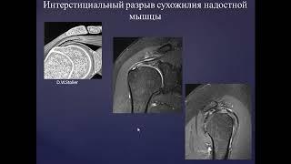 Базовый курс по МРТ  b  Лекция «МР семиотика повреждений плечевого сустава»  Лектор  Учеваткин А А