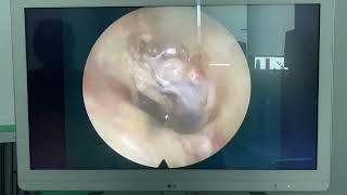 #Tympanomastoidectomy;Reconstruction ear drum and small bones of the middle earThe mastoid is opened