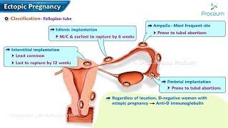 Ectopic Pregnancy: Classification, Pathogenesis, Clinical features, Diagnosis & Treatment