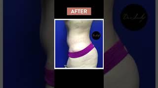 Plastic surgery Before and After | Tummy Tuck Surgery Before and After pictures Dr Jeneby