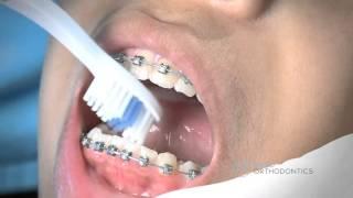 Brushing and Flossing with Braces in Columbia SC