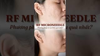 RF Microneedle - Phương Pháp Trị Sẹo Hiệu Quả Nhất? | Erutech Việt Nam