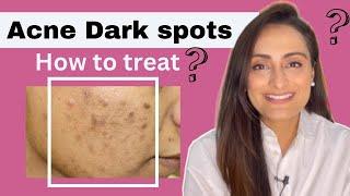 Acne Dark Spots | हिंदी | How to treat | serum cream recommendations | Dermatologist | Dr. Aanchal