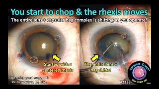 CataractCoach™ 2233: you start to chop & the capsulorhexis moves