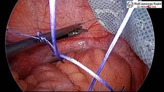 Intraperitoneal Onlay Mesh Repair of Inguinal Hernia