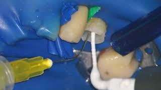 VDW Endodontic Irrigation EDDY Dental