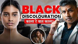 706:Black Discolouration | काला रे वात काला | Dr. Arun Mishra | Mishraveda