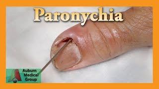 Drained Paronychia | Auburn Medical Group