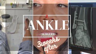 ANKLE SURGERY: How's the recovery 3 weeks after?